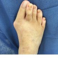 Expert Insights: Common Foot Problems in Older Adults