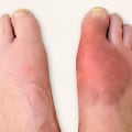 Expert Insights: The Impact of Foot Diseases and How to Prevent Them