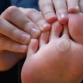 How to Remove Calluses From Feet Permanently: Proven Solutions From a Foot Specialist