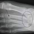 Lisfranc Fractures: A Comprehensive Guide from a Foot and Ankle Specialist