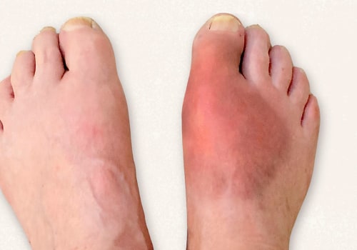 Expert Insights: The Impact of Foot Diseases and How to Prevent Them