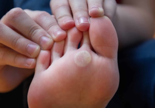 How to Remove Calluses From Feet Permanently: Proven Solutions From a Foot Specialist