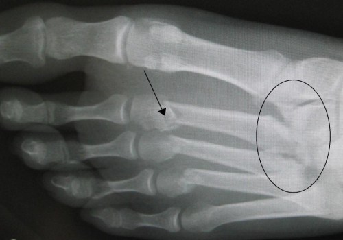 Lisfranc Fractures: A Comprehensive Guide from a Foot and Ankle Specialist